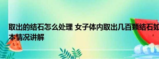 取出的结石怎么处理 女子体内取出几百颗结石如鱼子酱 基本情况讲解