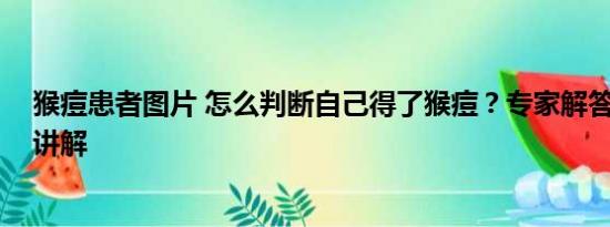 猴痘患者图片 怎么判断自己得了猴痘？专家解答 基本情况讲解