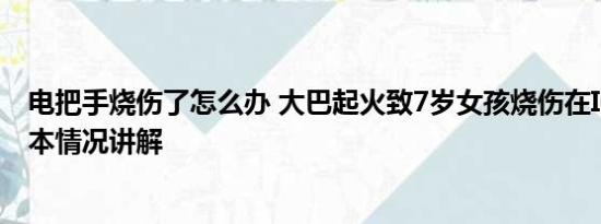 电把手烧伤了怎么办 大巴起火致7岁女孩烧伤在ICU救治 基本情况讲解