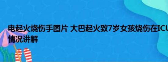 电起火烧伤手图片 大巴起火致7岁女孩烧伤在ICU救治 基本情况讲解