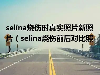 selina烧伤时真实照片新照片（selina烧伤前后对比照）